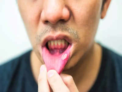 Mouth Ulcer Home Remedies: মুখের ঘায়ে কষ্ট পাচ্ছেন? ঘরোয়া উপায়ে সমস্যা মিটিয়ে নিন