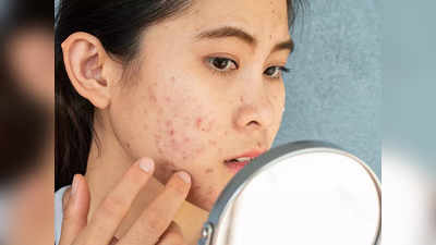 How to Prevent Acne: ব্রণর সমস্যা বছরভর? মেনে চলুন ডার্মাটোলজিস্টের এই ৩ টিপস