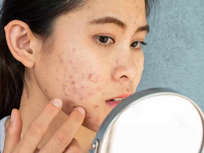 How to Prevent Acne: ব্রণর সমস্যা বছরভর? মেনে চলুন ডার্মাটোলজিস্টের এই ৩ টিপস