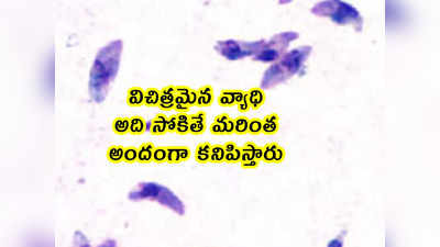 విచిత్రమైన వ్యాధి.. అది సోకితే మరింత అందంగా కనిపిస్తారు 