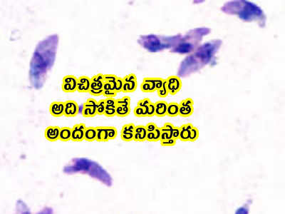 విచిత్రమైన వ్యాధి.. అది సోకితే మరింత అందంగా కనిపిస్తారు