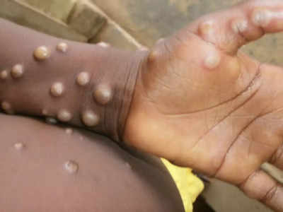 Monkeypox: बेहद आसान भाषा में समझिए क्या है मंकीपॉक्स वायरस, जानिए इलाज और लक्षण