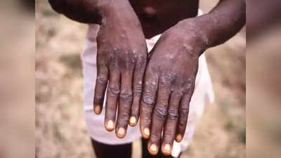 Monkeypox: সমকামী পুরুষদের মধ্যেই ছড়াচ্ছে মাঙ্কিপক্স! বাড়ছে আক্রান্তের সংখ্যা