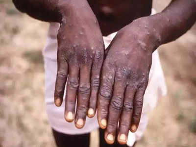 Monkeypox: সমকামী পুরুষদের মধ্যেই ছড়াচ্ছে মাঙ্কিপক্স! বাড়ছে আক্রান্তের সংখ্যা