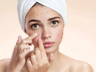 acne  : முகப்பரு... தழும்பு ஆகாம குணப்படுத்த என்னென்ன எசென்ஷியல் ஆயில் யூஸ் பண்ணலாம்? ஆய்வு சொல்வது என்ன?