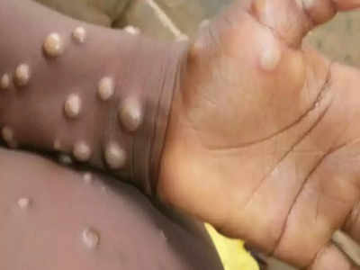 monkeypox in india : மங்கிபாக்ஸ், அறிகுறிகள், காரணங்கள், சிகிச்சைகள் தடுப்புமுறைகள்,  WHO சொல்வது என்ன?