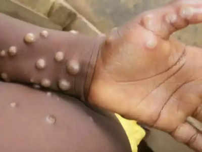 Monkeypox: হু হু করে ছড়াচ্ছে মাঙ্কিপক্স, আরও তিন দেশে মিলল আক্রান্তের সংখ্যা