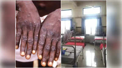 Monkeypox threat: కలవరపెడుతున్న మంకీపాక్స్.. ముంబైలో 28 పడకల ఐసోలేషన్ వార్డ్