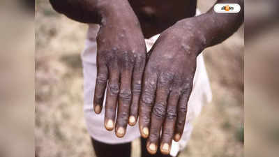 Monkeypox: বিদ্যুতের গতিতে ছড়াচ্ছে মাঙ্কিপক্স, নির্দিষ্ট কিছু দেশ থেকে ফিরলেই আইসোলেশন!