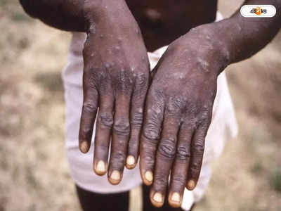 Monkeypox: বিদ্যুতের গতিতে ছড়াচ্ছে মাঙ্কিপক্স, নির্দিষ্ট কিছু দেশ থেকে ফিরলেই আইসোলেশন!