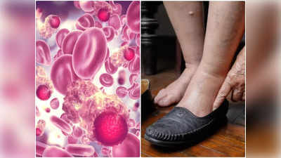 Pancreatic Cancer: पैरों में सबसे पहले दिखाई देने लगते हैं इस कैंसर के लक्षण, न आनें दें पहली स्‍टेज की नौबत