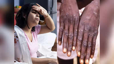 Monkeypox symptoms: पहले बुखार फिर शरीर पर बड़े-बड़े दाने, WHO ने बताए मंकीपॉक्स के 6 गंभीर लक्षण