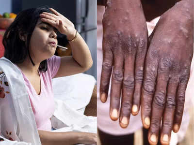 Monkeypox symptoms: पहले बुखार फिर शरीर पर बड़े-बड़े दाने, WHO ने बताए मंकीपॉक्स के 6 गंभीर लक्षण