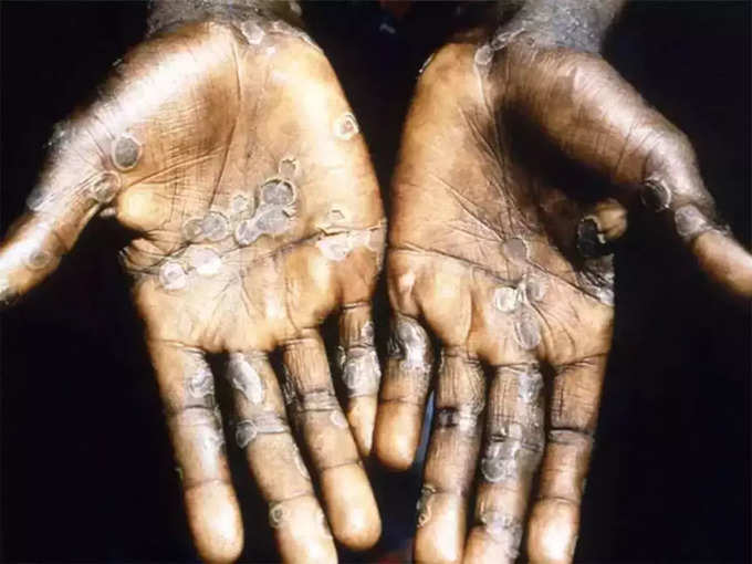 ​மங்கி பாக்ஸ் (monkeypox)