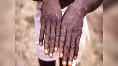 Monkeypox Update: মাঙ্কিপক্সের ভয়ে সিঁটিয়ে তামিলনাড়ু! আতঙ্কিত না হওয়ার বার্তা সরকারের