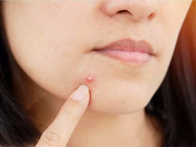 ​முகப்பரு (acne)