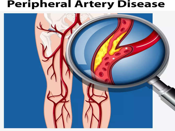 पेरिफेरल आर्टरी डिजीज (PAD) क्या है?
