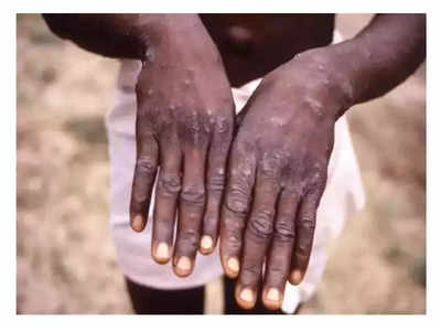 Monkeypox alert in UP: मंकी पॉक्स को लेकर यूपी के अस्पतालों में अलर्ट, बनी ये रणनीति, जानिए क्या हैं लक्षण-बचाव