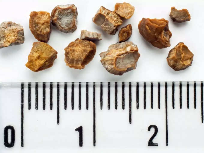 ​சிறுநீரகக் கற்களின் வகைகள் (types of kidney stones)