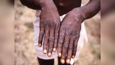 Monkeypox Disease : मंकीपॉक्स आजाराचा संसर्ग नेमका कसा होतो? तज्ज्ञ म्हणतात...