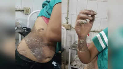 Muzaffarpur Acid Attack : तीन दिन पहले हुआ था हमला, अब तक FIR नहीं...  वाह री बिहार पुलिस