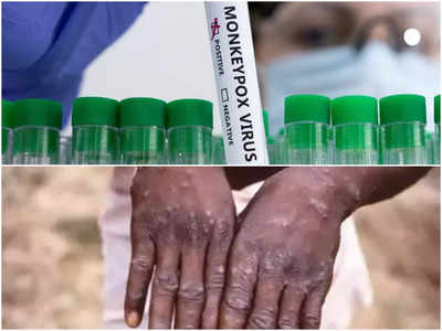 Monkeypox:మంకీపాక్స్ నిర్ధారణకు టెస్ట్‌ కిట్‌ను రూపొందించిన చెన్నై కంపెనీ