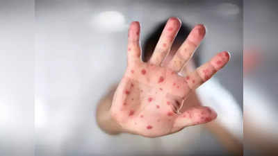 Monkeypox: মাঙ্কিপক্সে শিশুদের সংক্রমিত হওয়ার ঝুঁকি বেশি!