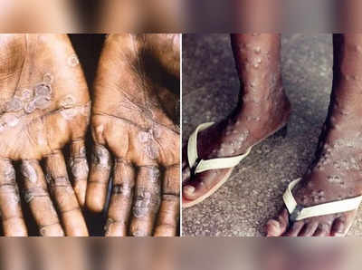 Monkeypox: இந்தியாவில் குரங்கம்மை பாதிப்பு? - மத்திய அரசு திடீர் விளக்கம்!