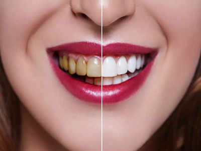 Dental care: सांस की बदबू, मसूड़ों में खून, पायरिया जैसी समस्याओं की जड़ हैं ये 6 बुरी आदतें