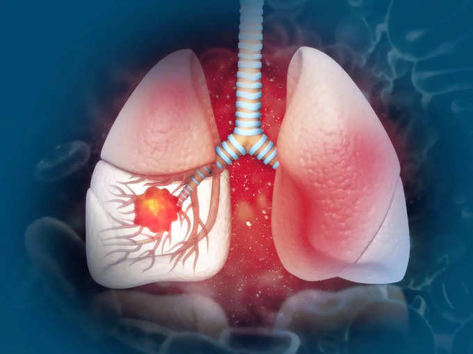 లంగ్ కాన్సర్ విషయంలో ఈ జాగ్రత్తలు తప్పనిసరి