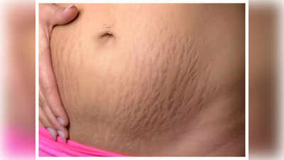 remedies for stretch marks: ஸ்ட்ரெச் மார்க்கை வேகமாக மறைய வெக்க இந்த நேச்சுரலான பொருள்களை மட்டும் யூஸ் பண்ணுங்க...