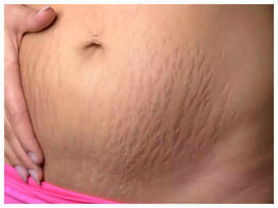 remedies for stretch marks: ஸ்ட்ரெச் மார்க்கை வேகமாக மறைய வெக்க இந்த நேச்சுரலான பொருள்களை மட்டும் யூஸ் பண்ணுங்க...