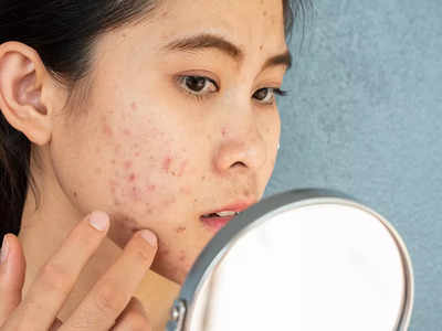 Best Acne Treatment: জল কম খান? ত্বকের জন্য কতটা ক্ষতি করছেন, চিকিৎসকের থেকে জেনে নিন...