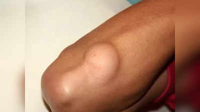 lipoma treatment: லிபோமா கொழுப்பு கட்டி ஏன் உண்டாகிறது? அதை சரிசெய்யும் இயற்கை வழிகள் என்ன...