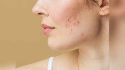 skin acne: முகப்பருக்கள் பற்றி இதுவரை உலவிவந்த கட்டுக்கதைகளும் உண்மைகளும்...