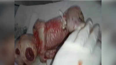 Ratlam Unique Child Birth News: एलियन जैसे बच्चे को देख हैरत में लोग, नवजात के शरीर पर स्किन नहीं, लड़का है या लड़की, यह भी नहीं पता