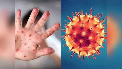<strong>Monkeypox vs COVID19 : </strong>करोनाला तगडी टक्कर देत तब्बल 30 देशांत मंकीपॉक्सचा फैलाव, दोन्हींची लक्षणे मिळती-जुळती, या 5 प्रकारे ओळखा फरक..!