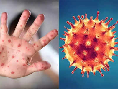 <strong>Monkeypox vs COVID19 : </strong>करोनाला तगडी टक्कर देत तब्बल 30 देशांत मंकीपॉक्सचा फैलाव, दोन्हींची लक्षणे मिळती-जुळती, या 5 प्रकारे ओळखा फरक..!