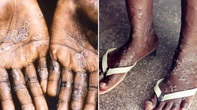 Monkeypox: காற்று மூலம் பரவும் குரங்கு அம்மை? - WHO திடீர் விளக்கம்!