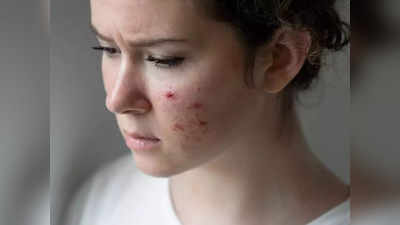 acne treatment: ஒரே நாளில் முகத்தில் உள்ள பருக்களை விரட்டுவது எப்படி? ரொம்ப ஈஸி...