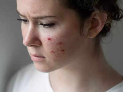 acne treatment: ஒரே நாளில் முகத்தில் உள்ள பருக்களை விரட்டுவது எப்படி? ரொம்ப ஈஸி...