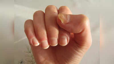 Nails fungus: ध्‍यान से देखें अपने नाखूनों का रंग, ये पीले नहीं सड़ने लगे हैं; ये हो सकती है 4 वजह