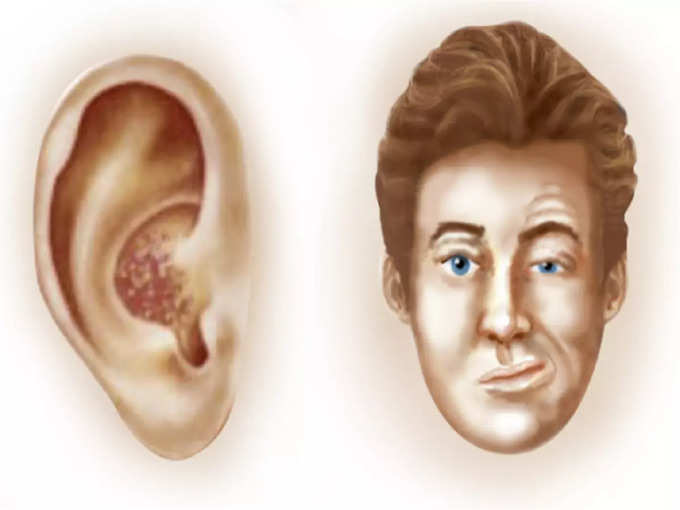 ​ராம்சே ஹன்ட் சிண்ட்ரோமின் ஆபத்து காரணிகள்