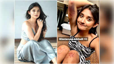 Khatron Ke Khiladi 12: टास्क में बुरी तरह जख्मी हुईं Kanika Mann, जल गया हाथ, पैरों पर आईं खरोंचे