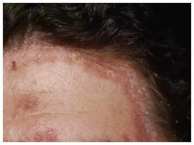 scalp psoriasis :வேகமாக முடி உதிர்வை உண்டாக்கும் உச்சந்தலை சொரியாசிஸ்.. அறிகுறிகளும் தவிர்க்கும் முறைகளும்!