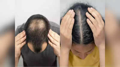 <strong>Baldness Treatment : </strong>तरूणपणात का पडू लागलंय मुला-मुलींचं टक्कल? औषधं न घेता हवे असतील लांबसडक, घनदाट व काळेभोर केस, तर करा Cosmetic Surgeon चे हे उपाय…!