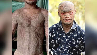 बिहार: सांप की तरह झड़ती है 25 वर्षीय युवक की त्वचा, इस दुर्लभ बीमारी से है पीड़ित
