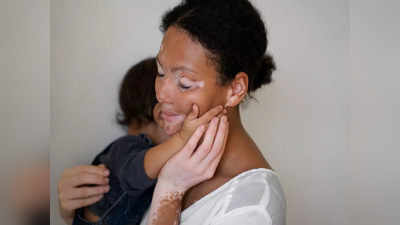 ज्यादा साबुन लगाने से हो जाता है शरीर पर सफेद दाग? जाने Vitiligo से जुड़े 4 सबसे बड़े डर का सच
