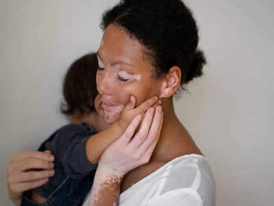 ज्यादा साबुन लगाने से हो जाता है शरीर पर सफेद दाग? जाने Vitiligo से जुड़े 4 सबसे बड़े डर का सच