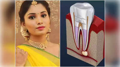 Root Canal केल्यानंतर अभिनेत्री स्वातीचा चेहरा झाला विचित्र, खरच ही ट्रिटमेंट असते का इतकी खतरनाक?